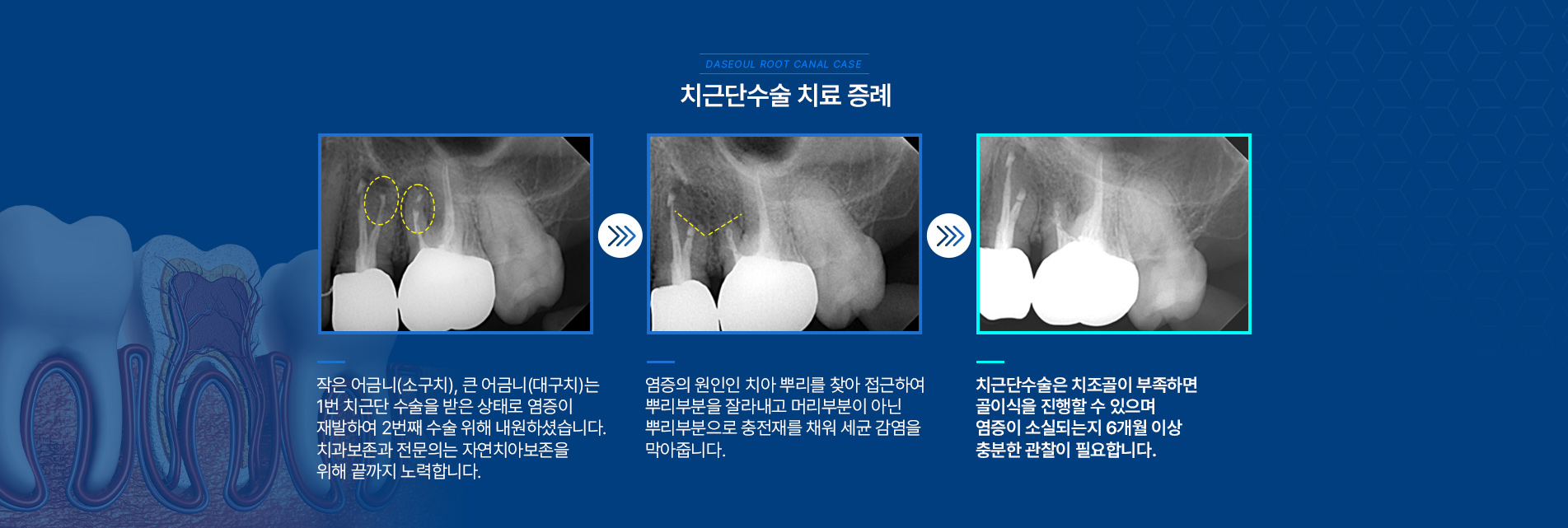 치근단수술 치료 증례